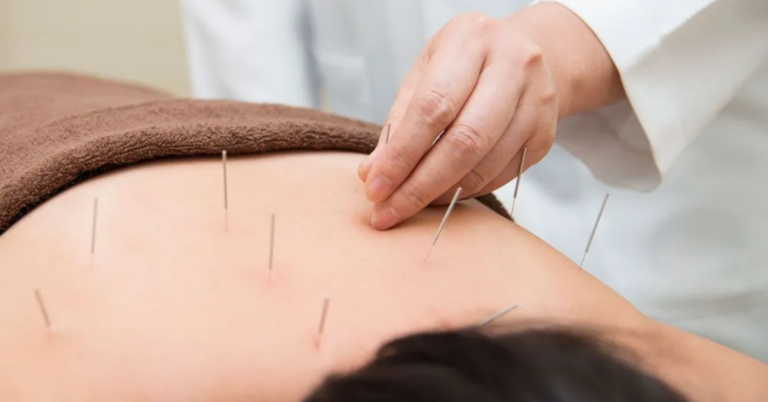 The Ultimate Guide to the Best TCM Acupuncture Practices for Optimal Health